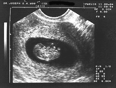 [Ultrasound imagery]